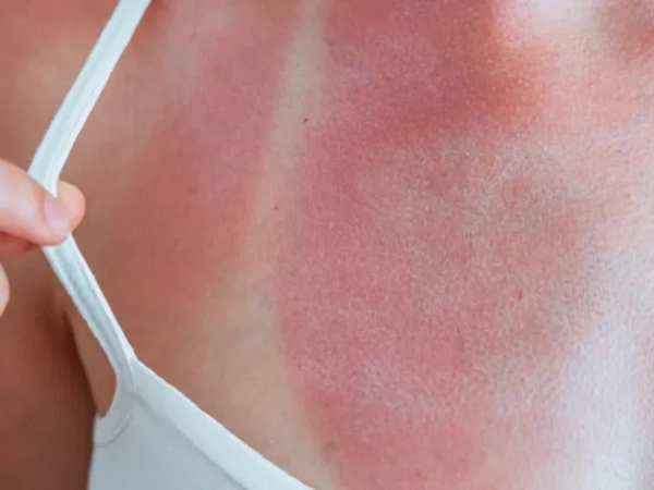 Lesiones solares que deben revisarse