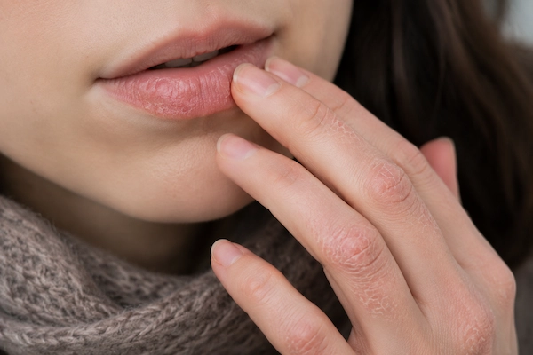 Labios y manos más vulnerables efectos del invierno en la piel